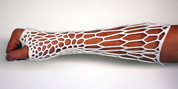 3D Printed Casts